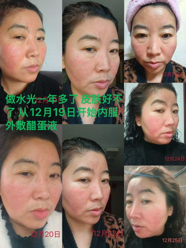 这个姐姐做水光1年多了，面部一直不好，起小脓点。使用醋蛋液一个月出头的效果！-智健家