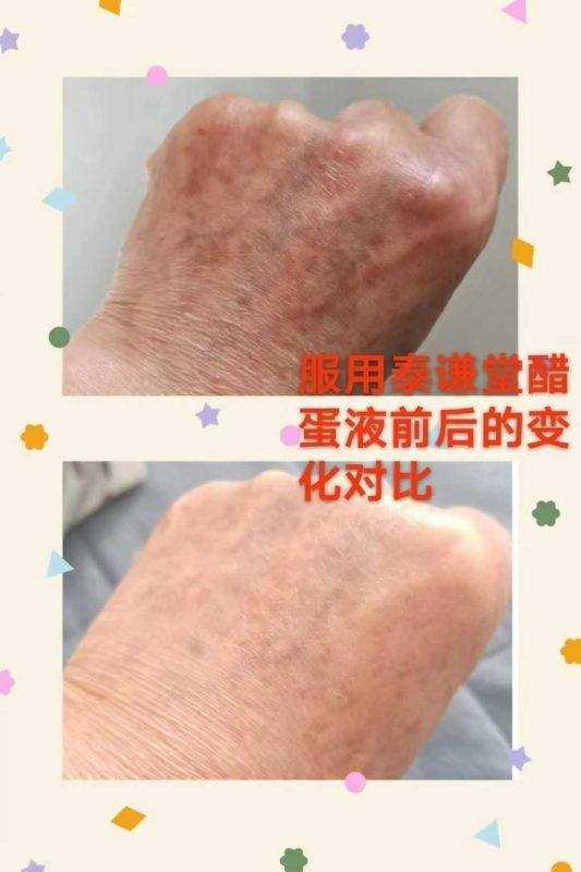 醋蛋归元液淡化手背老年斑-智健家