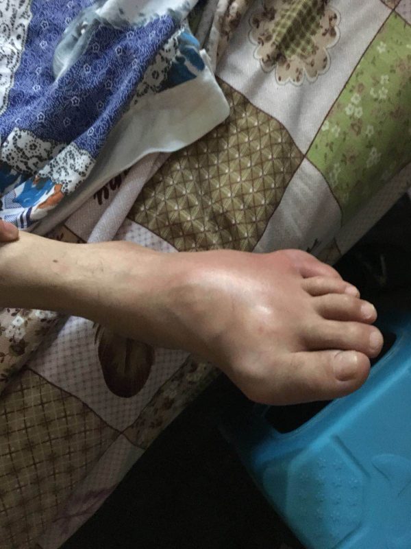 痛风患者脚肿胀变形，长年不能下床，按照我的指导，三天明显消肿，20天可以到外面溜达了。-智健家