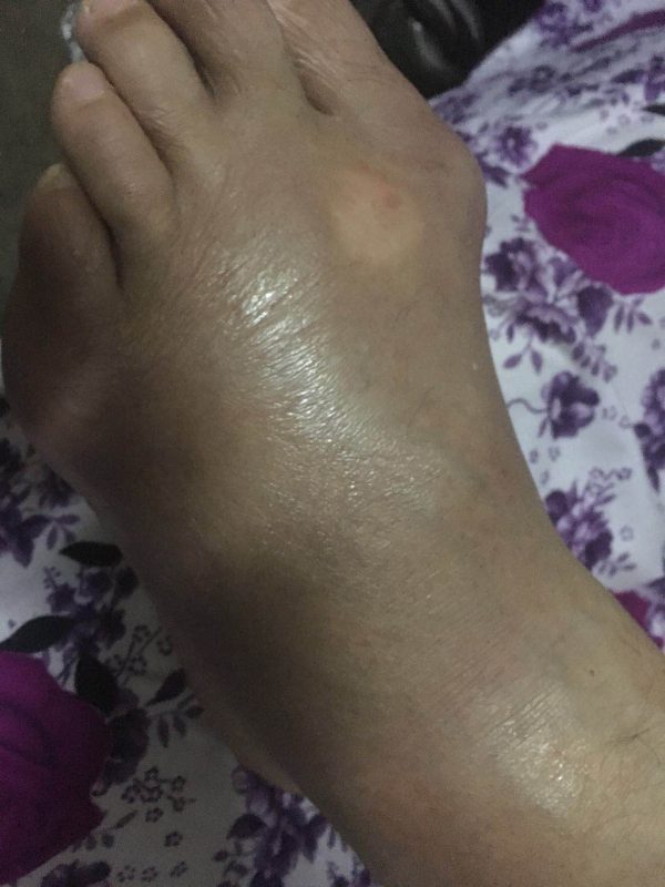 痛风患者脚肿胀变形，长年不能下床，按照我的指导，三天明显消肿，20天可以到外面溜达了。-智健家