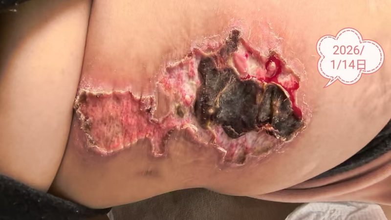 客户中焦淤堵下焦寒凉在中焦带脉位置艾灸之后显现出来的体质问题，后期用醋蛋液涂抹的修复过程-智健家