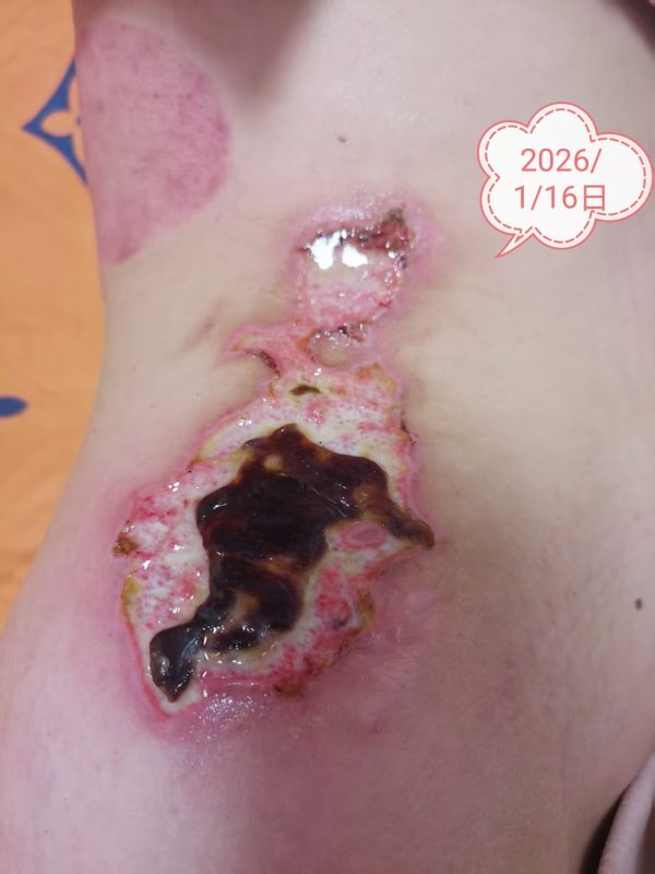 客户中焦淤堵下焦寒凉在中焦带脉位置艾灸之后显现出来的体质问题，后期用醋蛋液涂抹的修复过程-智健家