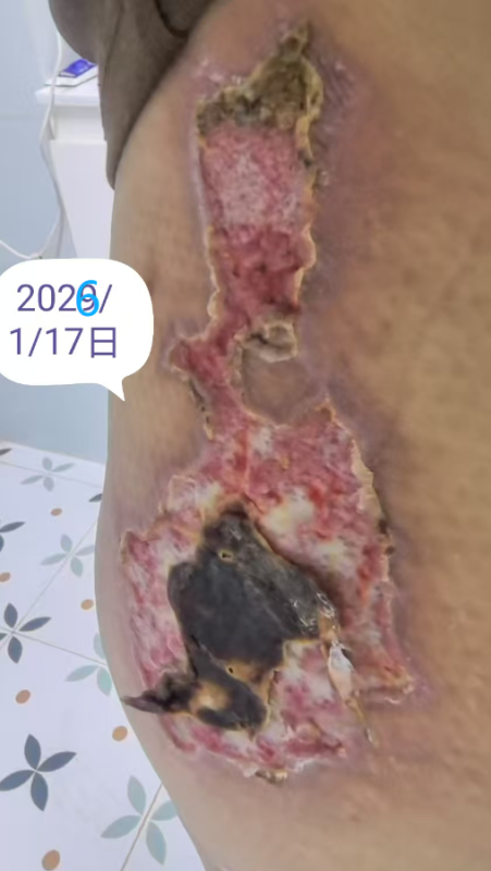 客户中焦淤堵下焦寒凉在中焦带脉位置艾灸之后显现出来的体质问题，后期用醋蛋液涂抹的修复过程-智健家