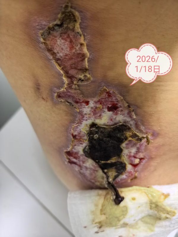 客户中焦淤堵下焦寒凉在中焦带脉位置艾灸之后显现出来的体质问题，后期用醋蛋液涂抹的修复过程-智健家