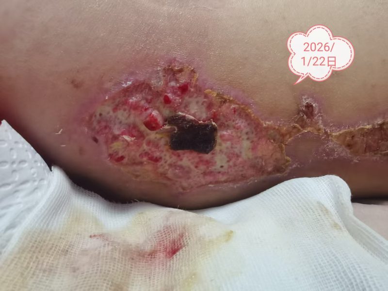 图片[5]-客户中焦淤堵下焦寒凉在中焦带脉位置艾灸之后显现出来的体质问题，后期用醋蛋液涂抹的修复过程-泰谦堂醋蛋液案例合集圈子社区-智健家