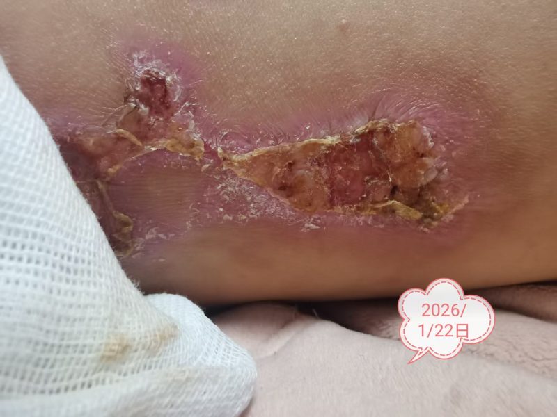 图片[6]-客户中焦淤堵下焦寒凉在中焦带脉位置艾灸之后显现出来的体质问题，后期用醋蛋液涂抹的修复过程-泰谦堂醋蛋液案例合集圈子社区-智健家