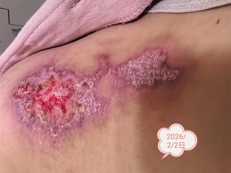 图片[7]-客户中焦淤堵下焦寒凉在中焦带脉位置艾灸之后显现出来的体质问题，后期用醋蛋液涂抹的修复过程-泰谦堂醋蛋液案例合集圈子社区-智健家