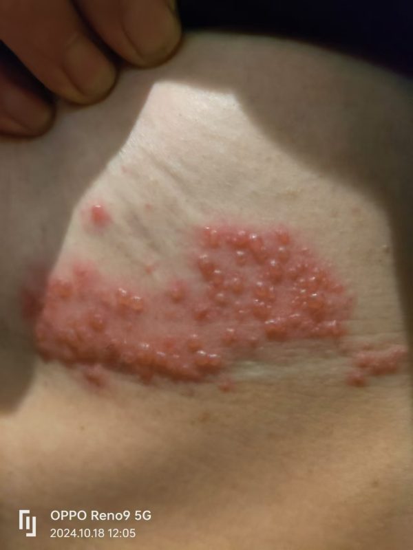 带状疱疹，口服➕外抹泰谦堂醋蛋归元液20天康复-智健家