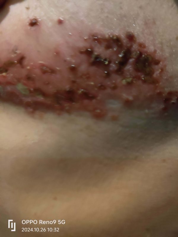 带状疱疹，口服➕外抹泰谦堂醋蛋归元液20天康复-智健家