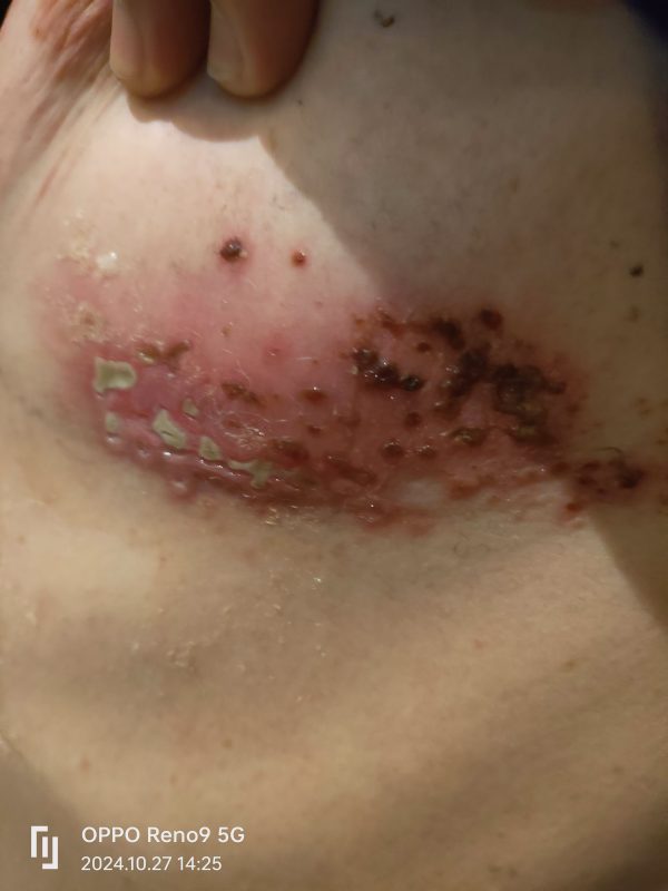 带状疱疹，口服➕外抹泰谦堂醋蛋归元液20天康复-智健家