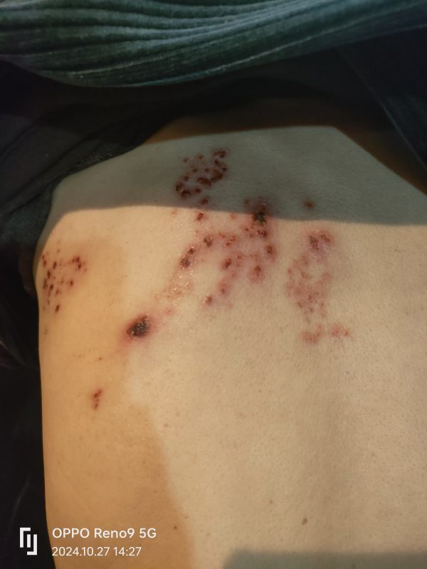 带状疱疹，口服➕外抹泰谦堂醋蛋归元液20天康复-智健家