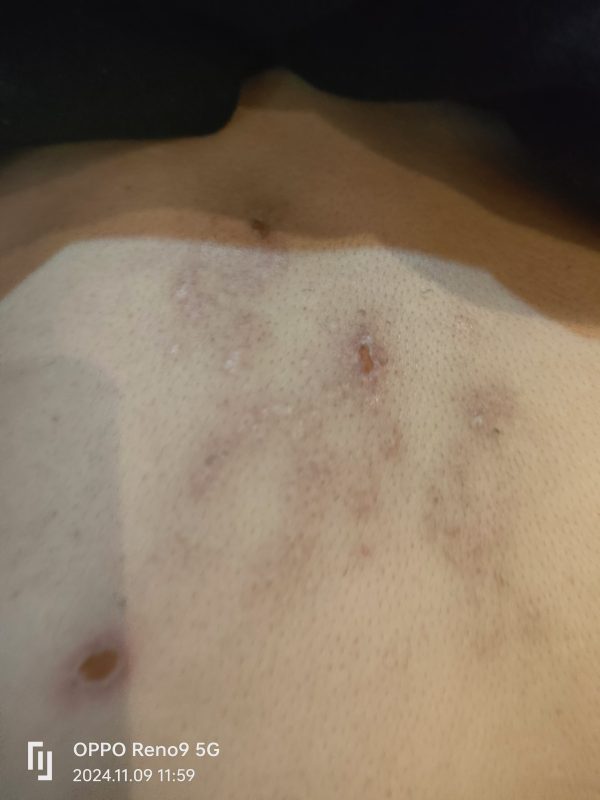 图片[5]-带状疱疹，口服➕外抹泰谦堂醋蛋归元液20天康复-泰谦堂醋蛋液案例合集圈子社区-智健家