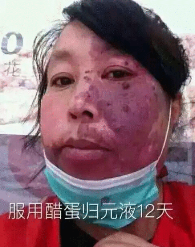 图片[10]-【泰谦堂醋蛋归元液调理皮肤病】手掌疱疹 荨麻疹 牛皮癣 湿疹 扁平疣 血管瘤 皮肤过敏案例-泰谦堂醋蛋液案例合集圈子社区-智健家