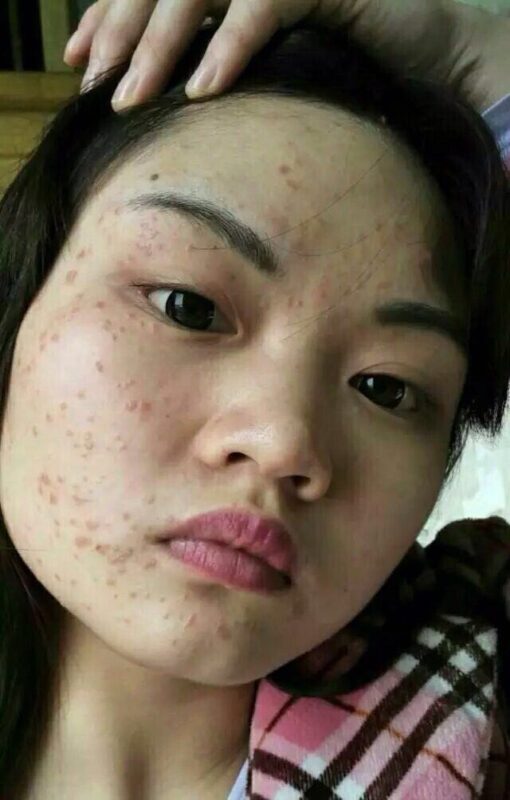 图片[11]-【泰谦堂醋蛋归元液调理皮肤病】手掌疱疹 荨麻疹 牛皮癣 湿疹 扁平疣 血管瘤 皮肤过敏案例-泰谦堂醋蛋液案例合集圈子社区-智健家