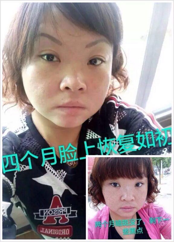 图片[12]-【泰谦堂醋蛋归元液调理皮肤病】手掌疱疹 荨麻疹 牛皮癣 湿疹 扁平疣 血管瘤 皮肤过敏案例-泰谦堂醋蛋液案例合集圈子社区-智健家