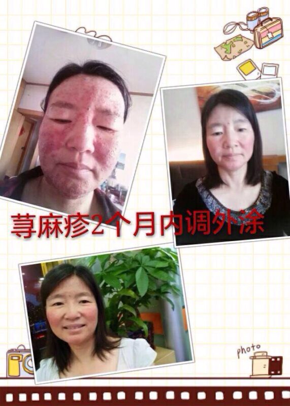 【泰谦堂醋蛋归元液调理皮肤病】手掌疱疹 荨麻疹 牛皮癣 湿疹 扁平疣 血管瘤 皮肤过敏案例-智健家