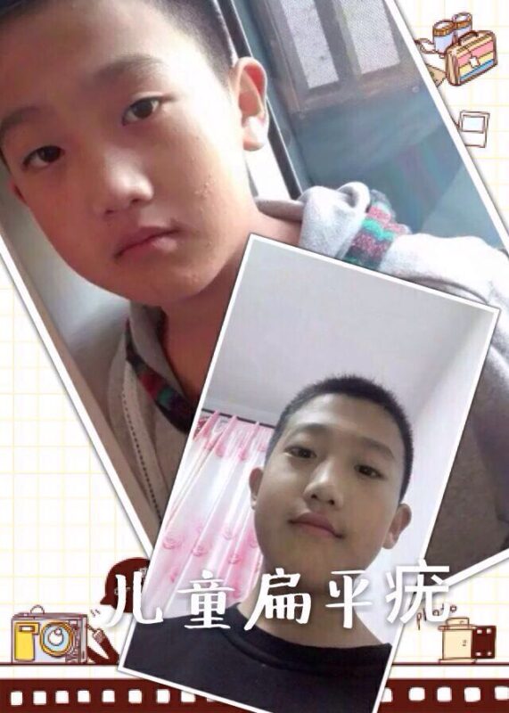 【泰谦堂醋蛋归元液调理皮肤病】手掌疱疹 荨麻疹 牛皮癣 湿疹 扁平疣 血管瘤 皮肤过敏案例-智健家