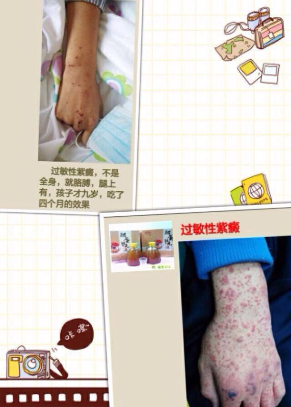 图片[6]-【泰谦堂醋蛋归元液调理皮肤病】手掌疱疹 荨麻疹 牛皮癣 湿疹 扁平疣 血管瘤 皮肤过敏案例-泰谦堂醋蛋液案例合集圈子社区-智健家