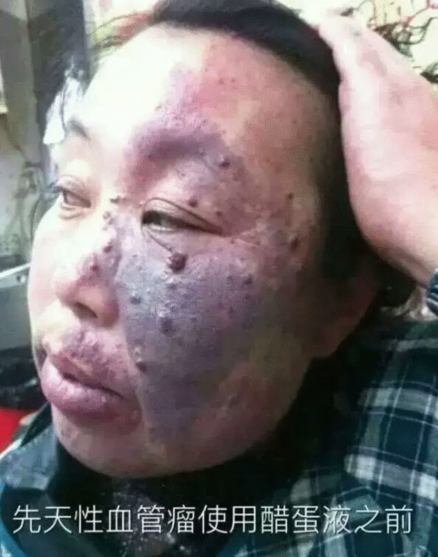图片[9]-【泰谦堂醋蛋归元液调理皮肤病】手掌疱疹 荨麻疹 牛皮癣 湿疹 扁平疣 血管瘤 皮肤过敏案例-泰谦堂醋蛋液案例合集圈子社区-智健家