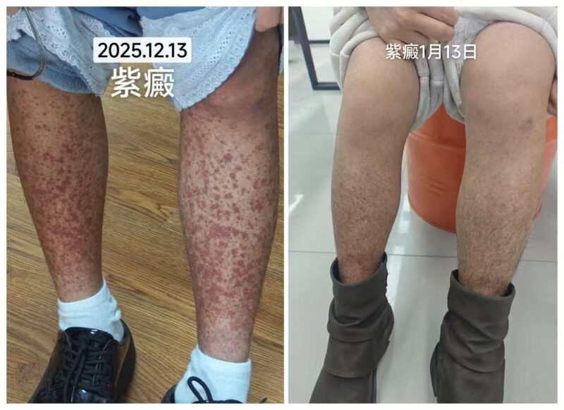 【视频】过敏性紫癜，用泰谦堂醋蛋归元液20天的效果-智健家