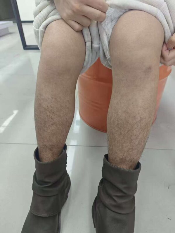 【视频】过敏性紫癜，用泰谦堂醋蛋归元液20天的效果-智健家