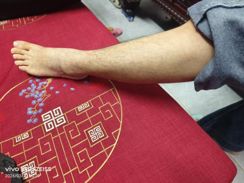 图片[5]-【视频】过敏性紫癜，用泰谦堂醋蛋归元液20天的效果-泰谦堂醋蛋液案例合集圈子社区-智健家