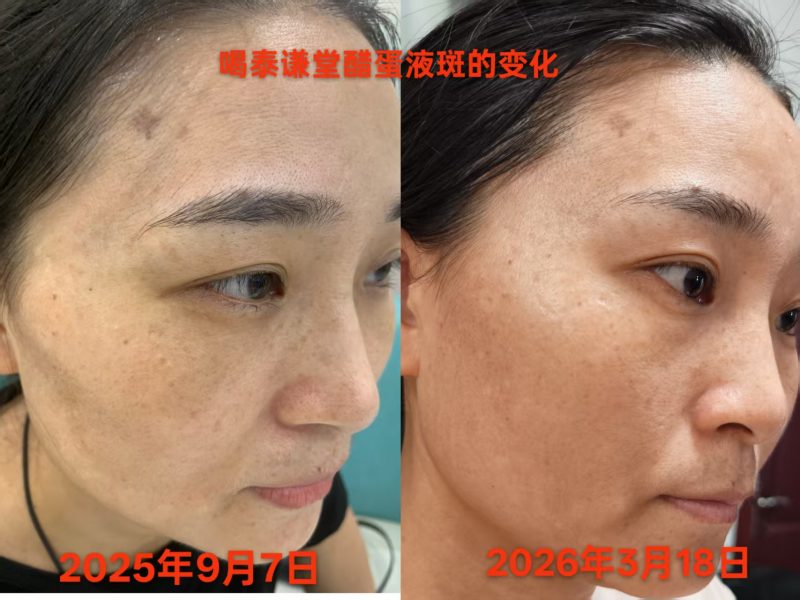 喝了醋蛋液半年的时间，脸上斑淡了很多，额头的青筋没有了-智健家