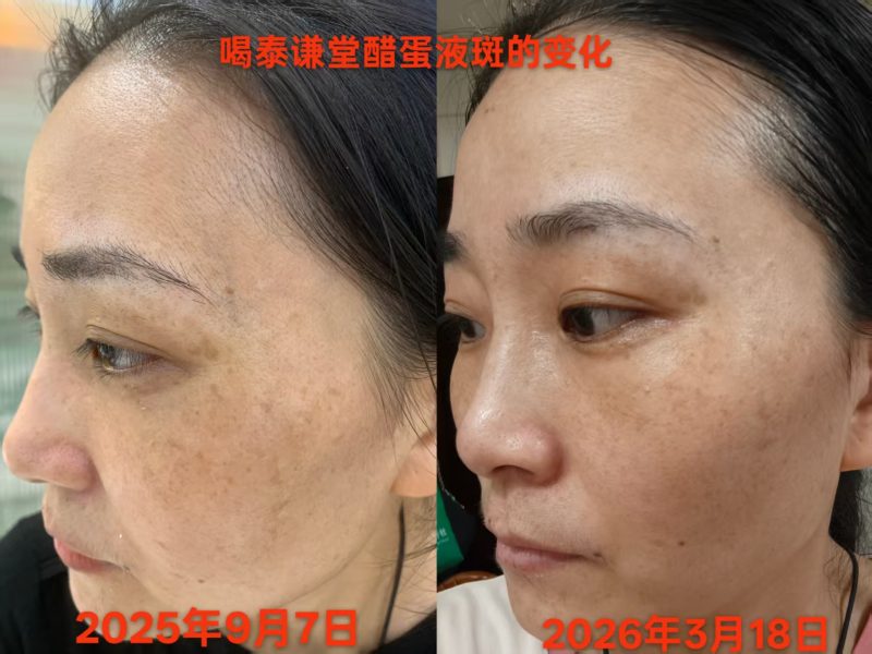 喝了醋蛋液半年的时间，脸上斑淡了很多，额头的青筋没有了-智健家