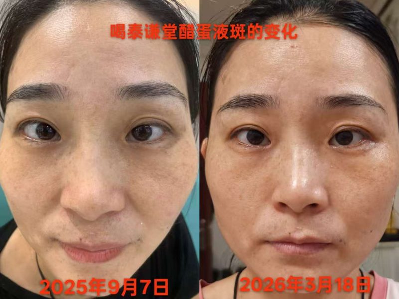 喝了醋蛋液半年的时间，脸上斑淡了很多，额头的青筋没有了-智健家