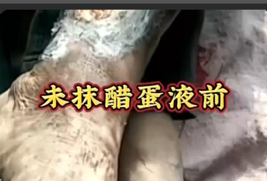 图片[2]-【视频】严重的脉管炎，喝了三个月泰谦堂醋蛋归元液，开始改善了-泰谦堂醋蛋液案例合集圈子社区-智健家