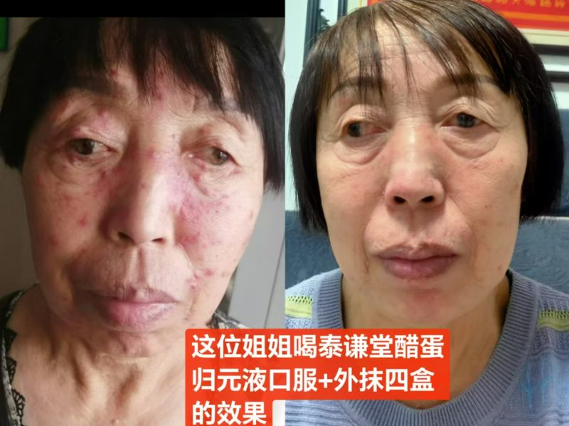 这位姐姐喝泰谦堂醋蛋归元液 面部变化 内服+外用 使用4盒的分享-智健家
