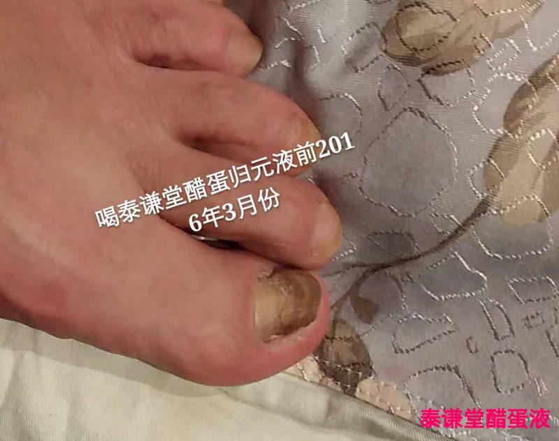 以前的灰趾甲灰指甲，就让我的脚丫子更丑了！-智健家
