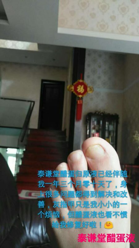 以前的灰趾甲灰指甲，就让我的脚丫子更丑了！-智健家