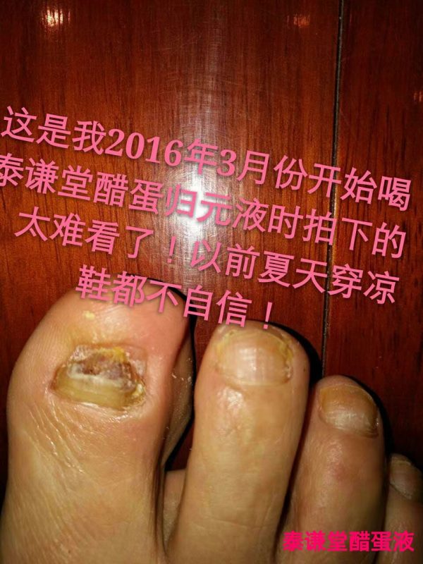 以前的灰趾甲灰指甲，就让我的脚丫子更丑了！-智健家