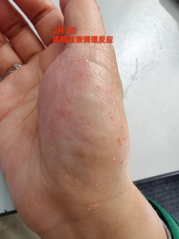 本人的水泡湿疹手掌疱疹，到现在20年了-智健家