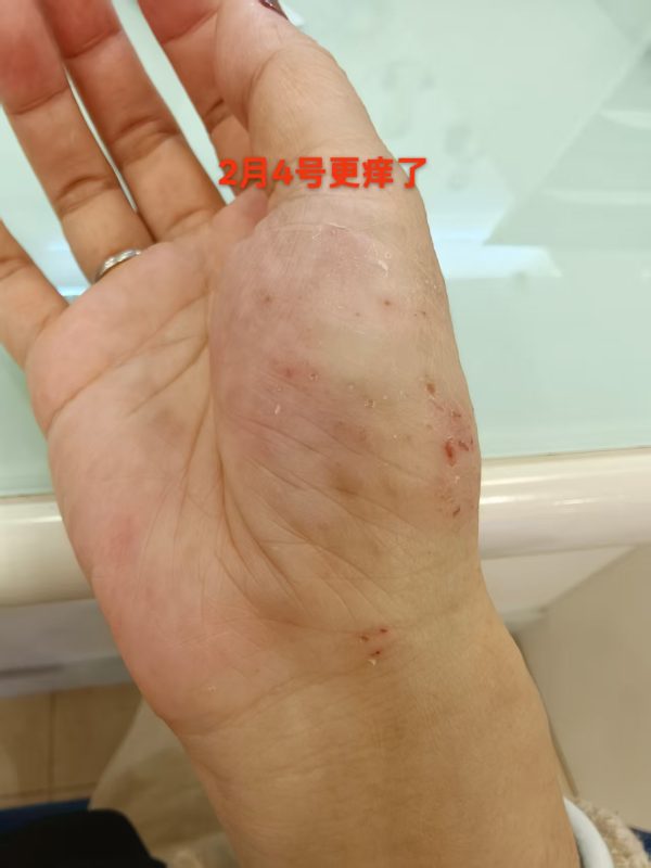 本人的水泡湿疹手掌疱疹，到现在20年了-智健家