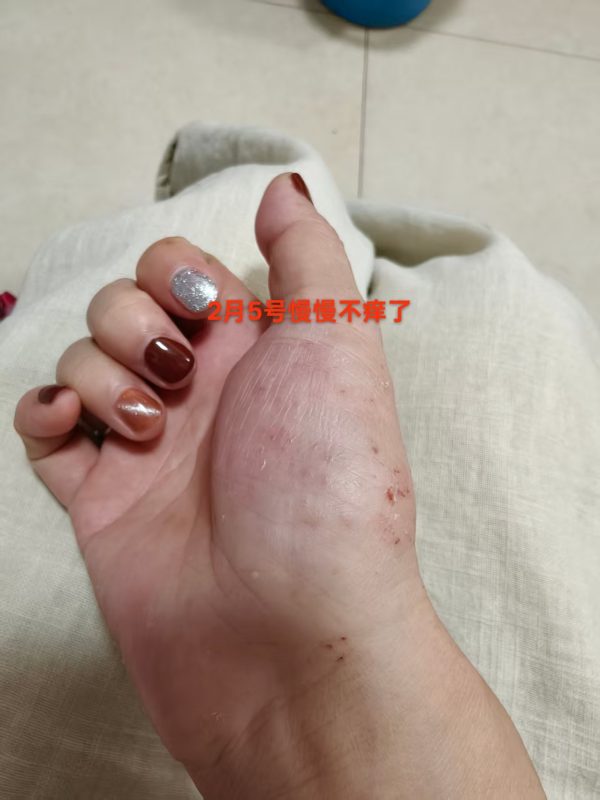 本人的水泡湿疹手掌疱疹，到现在20年了-智健家