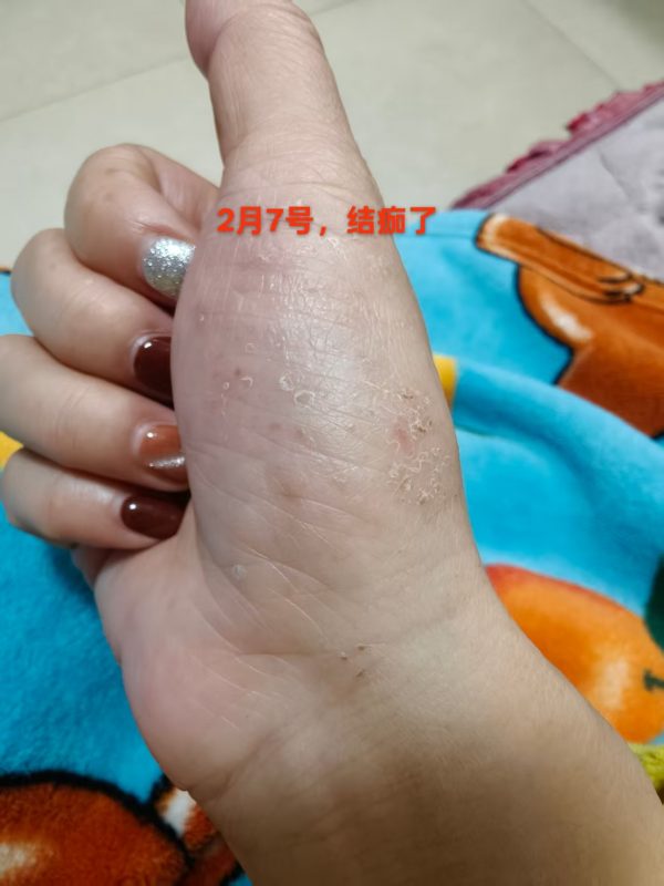 本人的水泡湿疹手掌疱疹，到现在20年了-智健家