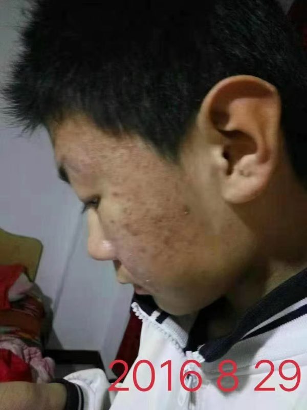 毒疮疤痕喝醋蛋液排了1个月的时间，脸上的毒疮疤也好了差不多，免疫力也提高了-智健家