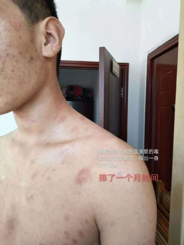 毒疮疤痕喝醋蛋液排了1个月的时间，脸上的毒疮疤也好了差不多，免疫力也提高了-智健家
