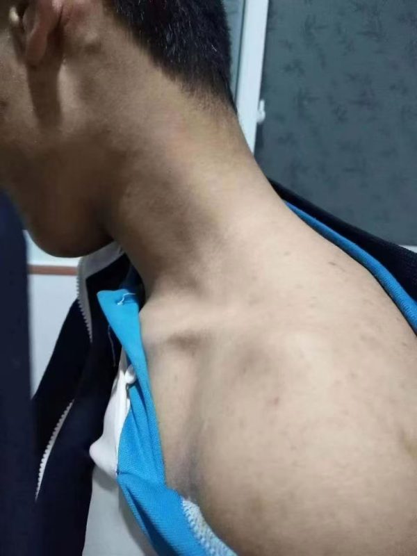 毒疮疤痕喝醋蛋液排了1个月的时间，脸上的毒疮疤也好了差不多，免疫力也提高了-智健家