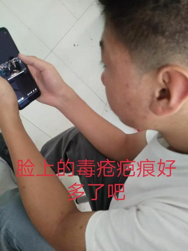 毒疮疤痕喝醋蛋液排了1个月的时间，脸上的毒疮疤也好了差不多，免疫力也提高了-智健家