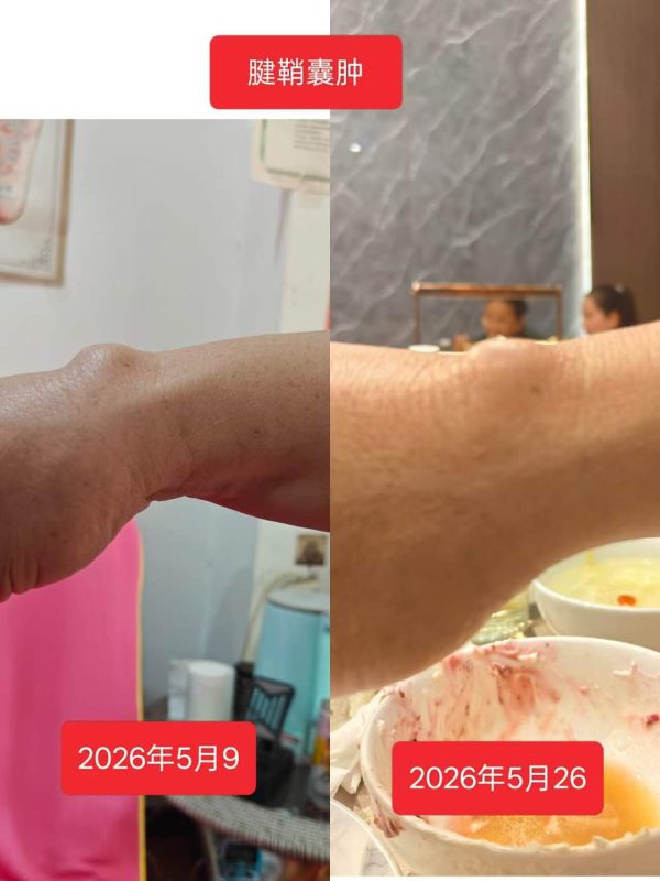 鹤壁市场最新用户分享，腱鞘囊肿喝醋蛋液15天，不疼了-智健家