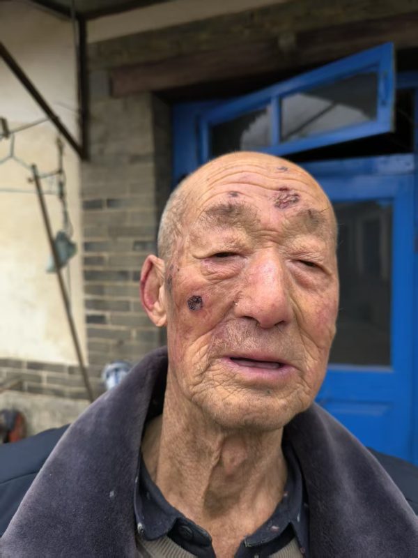 【视频】我舅公公脸上蛇盘疮治了一年多，花了一万多元钱没好，2025年正月初二开始喝醋蛋归元液，脚上是糖尿病并发症，连喝带抹一个月的效果-智健家