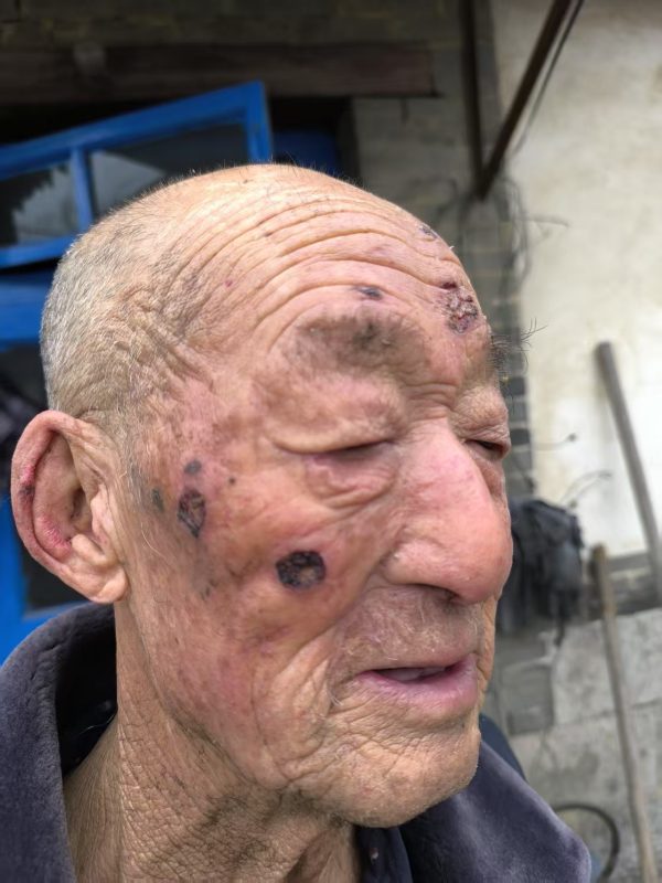 【视频】我舅公公脸上蛇盘疮治了一年多，花了一万多元钱没好，2025年正月初二开始喝醋蛋归元液，脚上是糖尿病并发症，连喝带抹一个月的效果-智健家