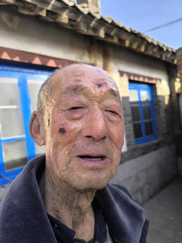 【视频】我舅公公脸上蛇盘疮治了一年多，花了一万多元钱没好，2025年正月初二开始喝醋蛋归元液，脚上是糖尿病并发症，连喝带抹一个月的效果-智健家