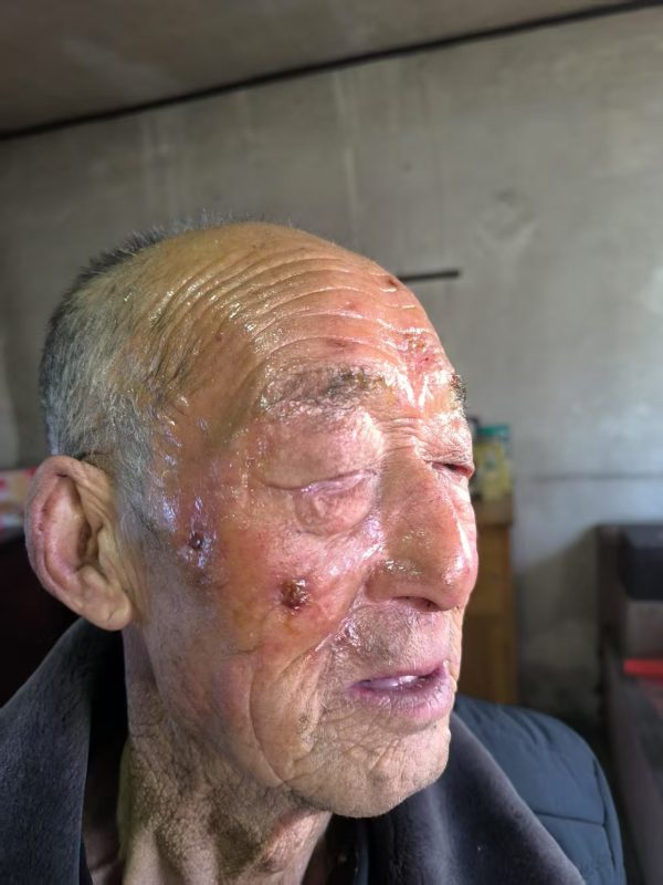 【视频】我舅公公脸上蛇盘疮治了一年多，花了一万多元钱没好，2025年正月初二开始喝醋蛋归元液，脚上是糖尿病并发症，连喝带抹一个月的效果-智健家