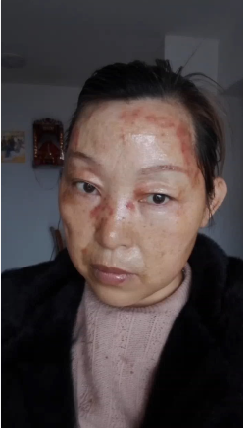 【视频】这位姐姐脸上排出来的毒素，整整一个月连喝带抹，醋蛋液大变美女-智健家
