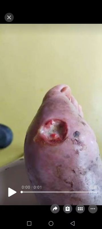 客户因为痛风做手术后伤口一个月都不愈合，反复流脓。用醋蛋液一早上竟然结痂啦-智健家