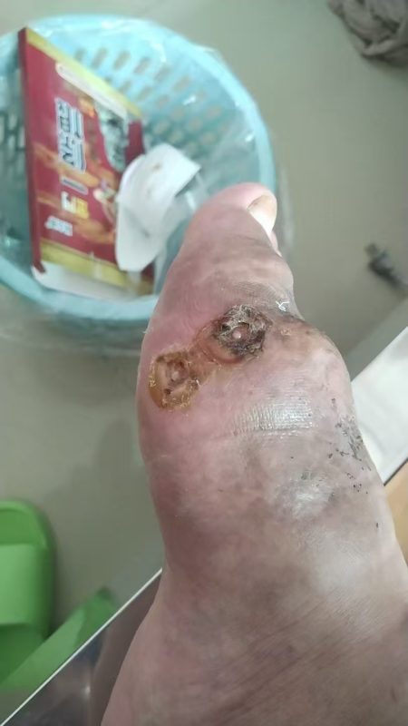客户因为痛风做手术后伤口一个月都不愈合，反复流脓。用醋蛋液一早上竟然结痂啦-智健家